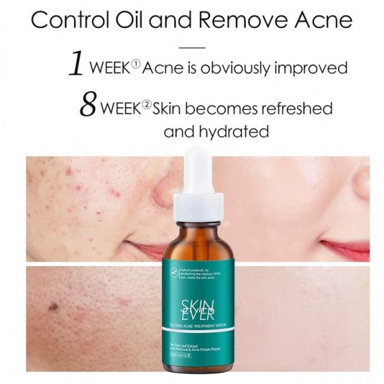 Skin Ever Tea Tree Acne Treatment Serum 30ml